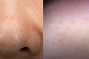 最近被問很多的事：鼻頭粉刺怎麼去除？