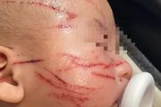 心碎！澳洲華人男嬰在幼稚園被抓成「貓臉」，他才10周大呀！園方更曝歧視言論，華人媽媽都氣炸了&#8230;