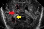 胎兒或者出生後脈絡叢囊腫怎麼辦？