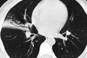肺炎支原體肺炎時，CT怎麼看？