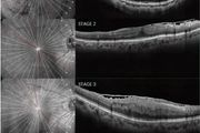 BMC子刊：40歲以下黃斑視網膜前膜患者的臨床研究