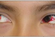發熱咳嗽後，孩子眼睛發紅是怎麼回事？