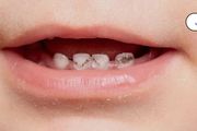 嬰兒牙齒上出現小黑點是蛀牙嗎？真相和你想的不一樣