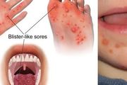 手足口病或者皰疹性咽峽炎，白細胞高怎麼辦？