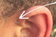 嬰兒耳朵旁有這種小洞？小心，別亂碰