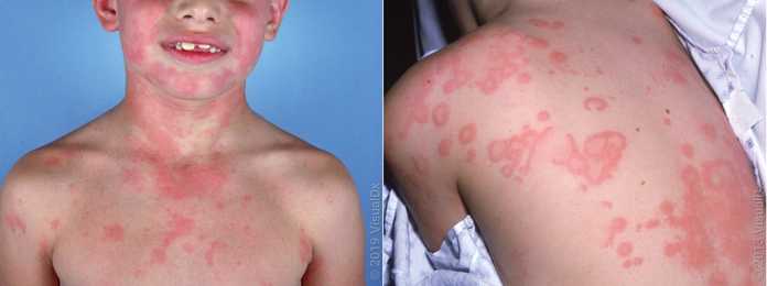 蕁麻疹，圖片來源見水印