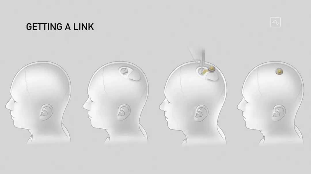 馬斯克的Neuralink公司開發的可以植入人腦的晶片，屆時人類將可以腦電波來操作機械人機合一的「最